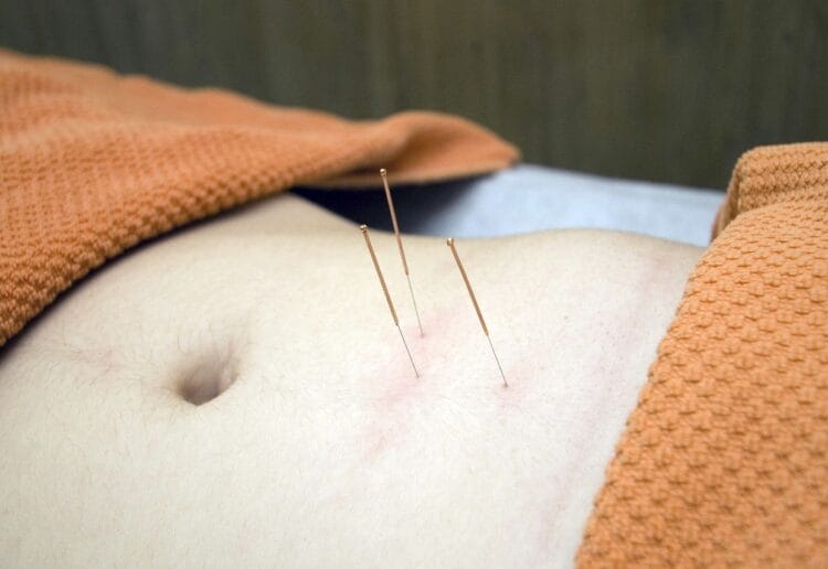An hour of acupuncture is one of the prizes on offer for the Berkshire Music Trust's charity raffle Picture: Pixabay