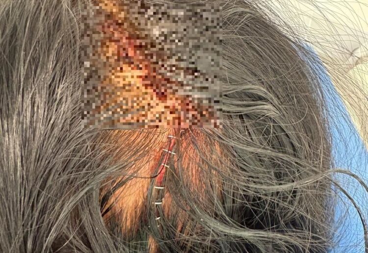 The head cut Sonia Gill suffered after an accidental fall. She accused a doctor of making inappropriate comments about women while being cared for at the Royal Berkshire Hospital in Reading. Credit: Sonia Gill